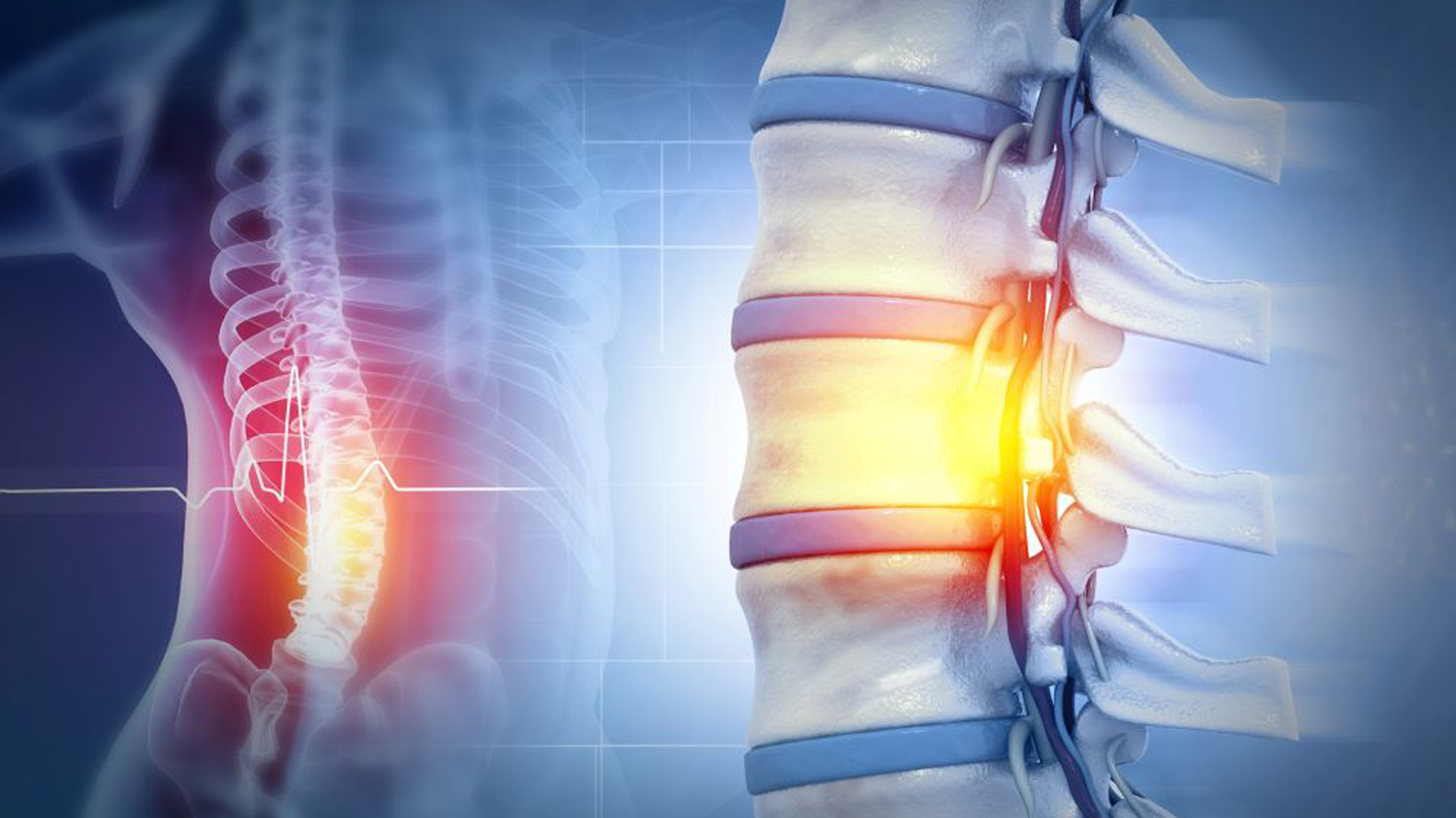 Vertebrogram Traumatismele vertebro-medulare: de la diagnostic la recuperare | Arcadia